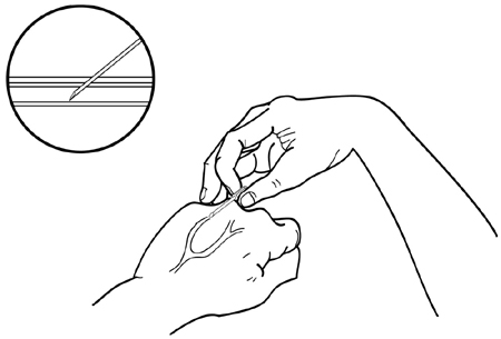 Fig 4-18 needle entering vein Fig 4-18 needle entering vein