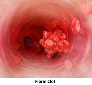 Fibrin Clot