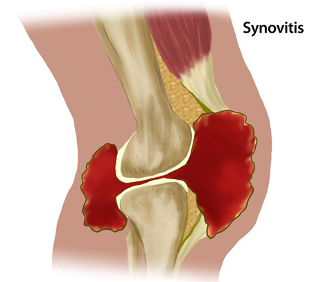 Figure 1-9 Synovitis